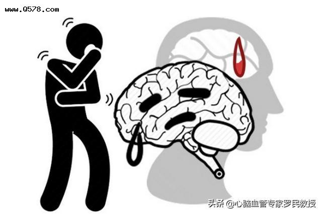 脑梗在发病前通常会出现哪些“求救信号”？