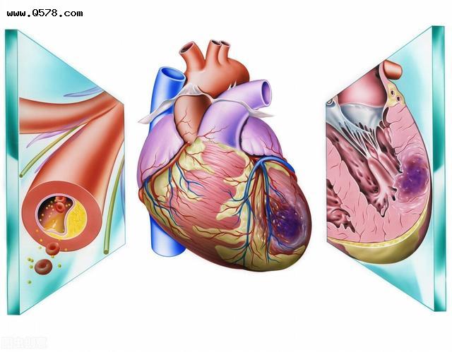 心梗发作时，身体会有哪些表现？