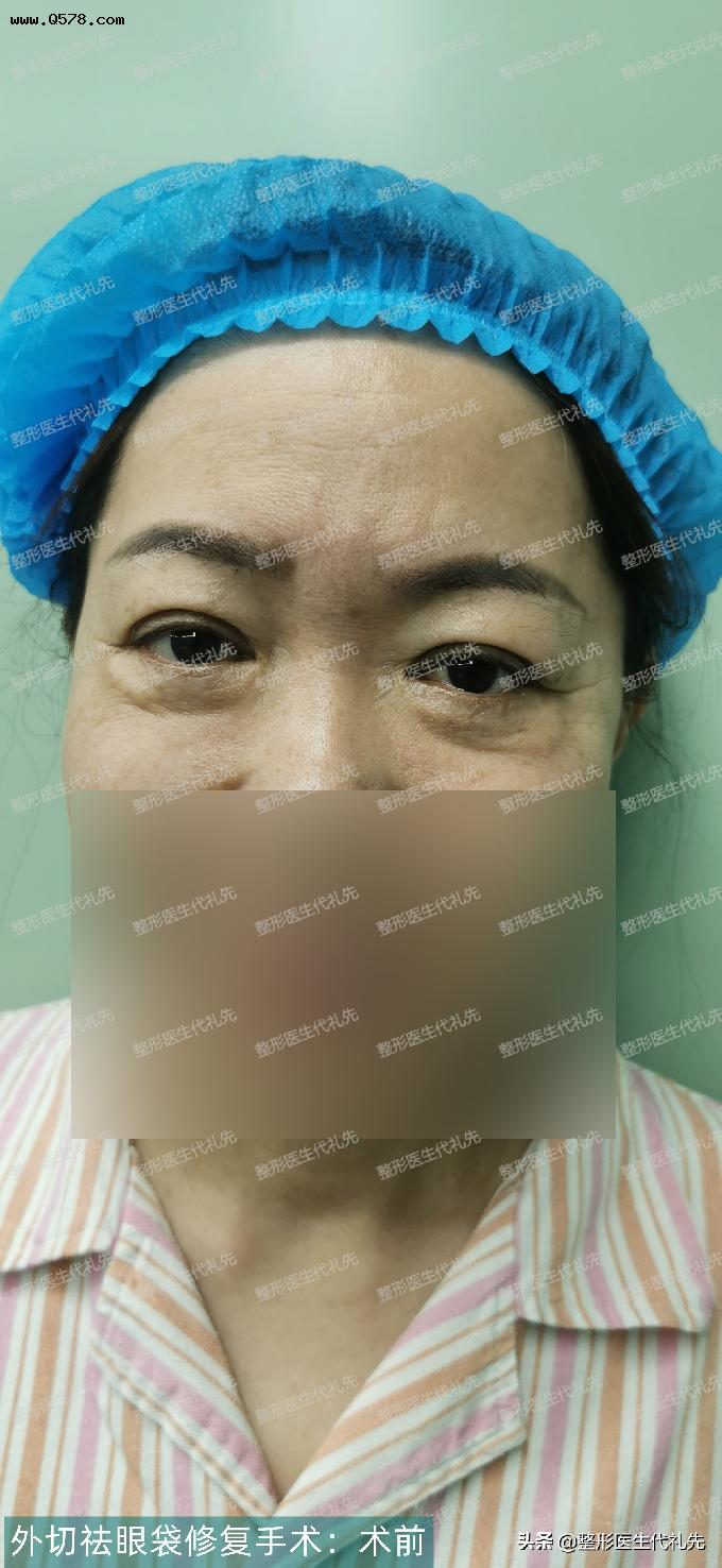 53岁来北京做了外切祛眼袋修复手术，女士说术后效果真的是太好了
