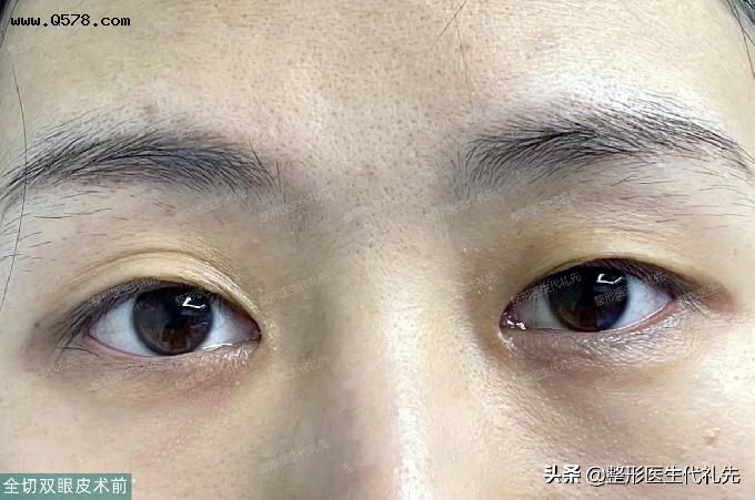 40岁，女士来北京做了全切双眼皮，术后即刻、半年来反馈恢复效果