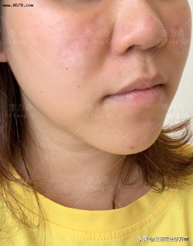 30岁女士不忍面部臃肿，来北京做注射物取出，都说她骨相美更耐看