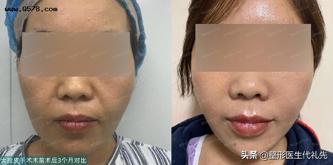 46岁下决心来北京做了大拉皮手术，术前术后3个月消肿紧致对比