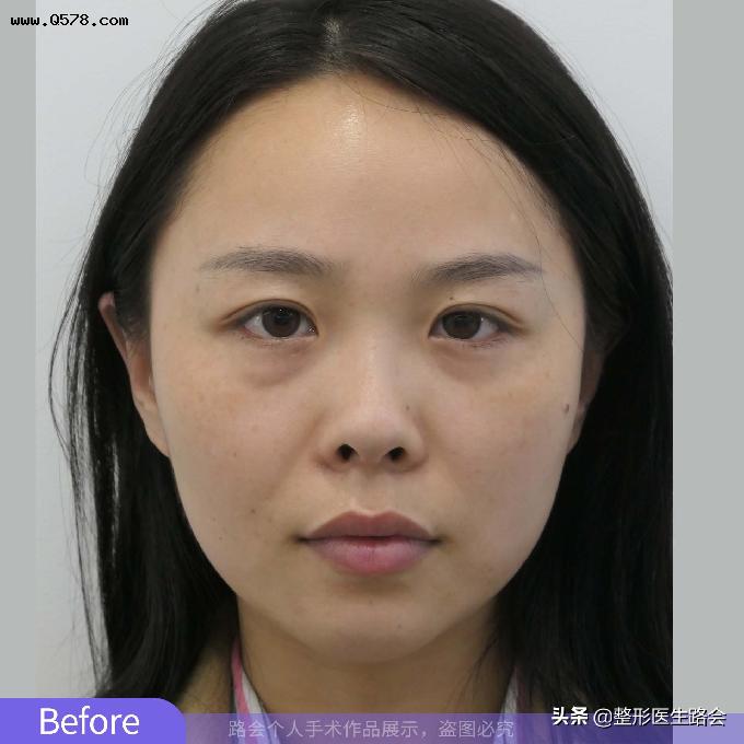 拒绝“自体骨隆鼻”，28岁姑娘独自来京整形，术后109天气质改变