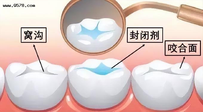 涂氟与窝沟封闭相比，哪个防止蛀牙更有效？