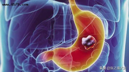 胃癌通过什么检查最准确？