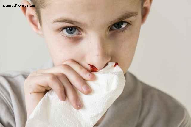 孩子经常流鼻血，可能有这3个原因，家长一定要警惕