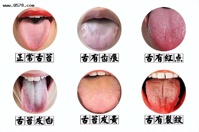 舌头两边呈锯齿状，是什么原因造成的呢？