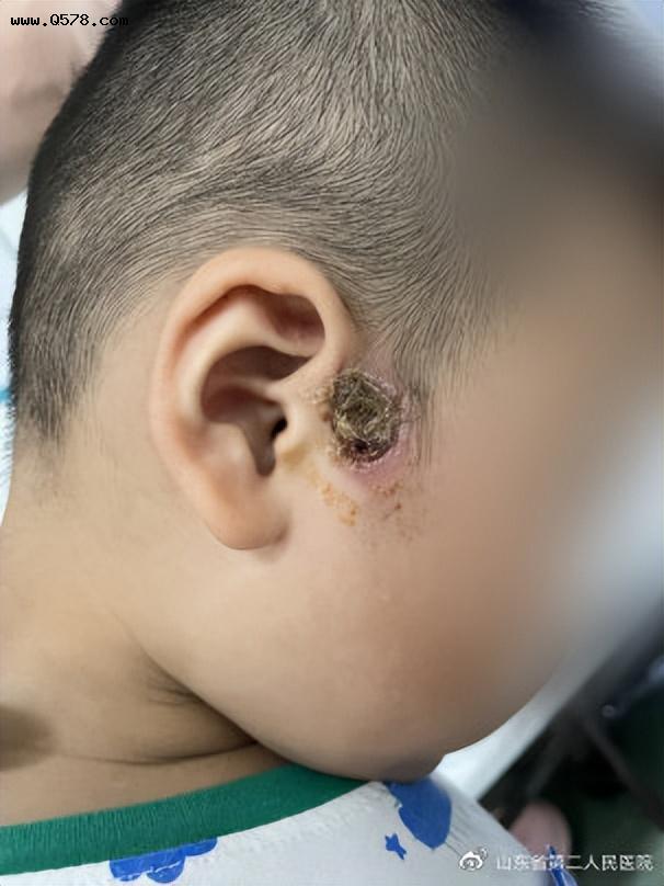 3岁男孩横跨半个中国，只为治愈耳前瘘管！耳仓是“祸”不是福