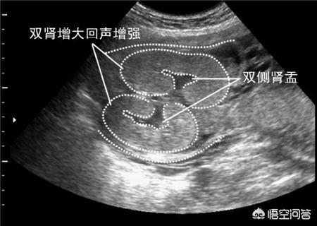 怀孕五个月，B超检查说胎儿双肾盂分离，这是什么原因？