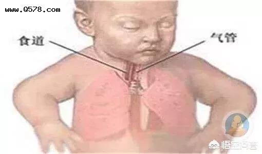 肺炎真可怕，如何保护儿童生命健康？